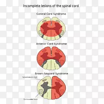 脊髓损伤脊髓前动脉综合征中央脊髓综合征-脊髓