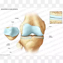 膝关节骨折、胫骨病理学-rán 3d