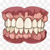 牙颌义齿咀嚼磨牙-牙槽