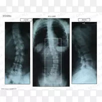 X线放射学医学影像海报-脊柱侧凸