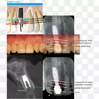 牙种植体牙骨质釉质接合牙科上颌窦定位板