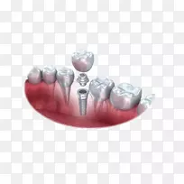 牙科种植牙.牙齿的牙科解剖