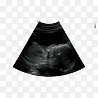 超声技术4d胶卷婴儿黑m日根除产科瘘管