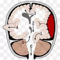 脑疝颅内压脑瘤