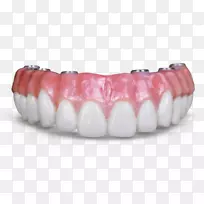 牙科种植义齿牙科假体固定修复牙桥