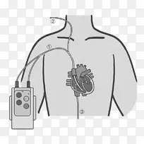 人工心脏起搏器护理医疗设备说明自动体外除颤器.额外体隔成形术