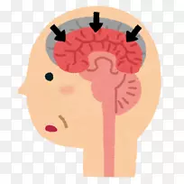 阿尔茨海默病，路易体痴呆，血管性痴呆，脑-脑