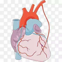 心肌梗塞心脏单核细胞冠状动脉疾病医学夹艺术解剖心脏艺术