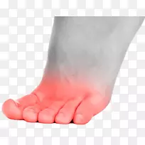 足趾骨痂病痛风足问题