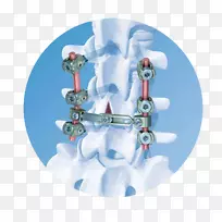 脊柱DePuy合成公司骨接合，脊髓垂直可扩展人工钛肋骨-骨螺钉