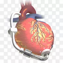 心室辅助装置心脏移植人工心脏五金泵心脏