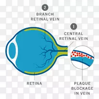 闪光失明视网膜中央静脉阻塞眼睛标志.风湿科图
