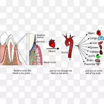 牙菌斑系统疾病牙周病细菌-动脉粥样硬化图示