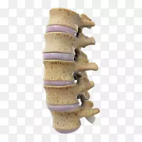 腰椎骶骨矢状面-硬膜外坐骨神经痛