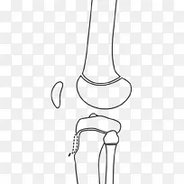 人腿 骨折 胫骨粗隆