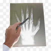 手指X光片