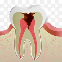 蛀牙牙痛坡面图